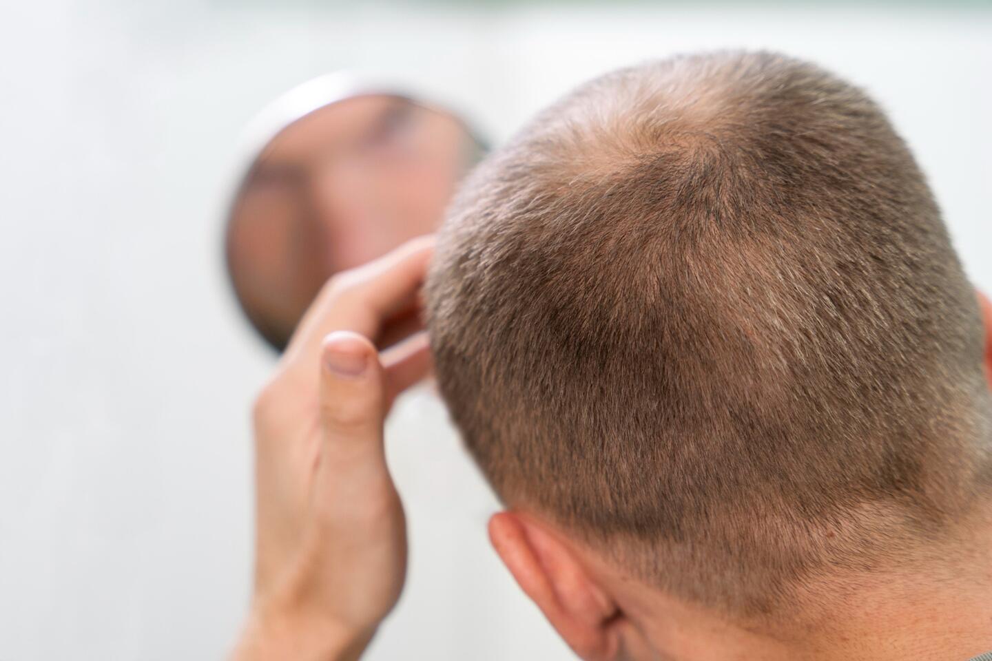 Conheça as marcas de Minoxidil Foligain e Rogaine