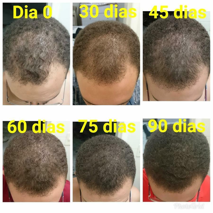 Queda de cabelo: O que causa e como resolver?